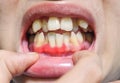 Inflammation of gum called gingivitis. Periodontal problem