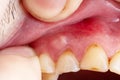 Inflammation of the gums abscess closeup,