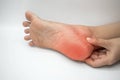 Inflammation at heel. Concept of foot pain Royalty Free Stock Photo