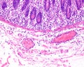 Inflammation. Leucocyte diapedesis