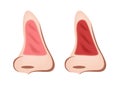 Inflammation of nasal mucosa vector / rhinitis Royalty Free Stock Photo