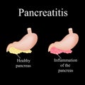 Inflammation of the pancreas. Pancreatitis. The Royalty Free Stock Photo