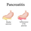 Inflammation of the pancreas. Pancreatitis. Vector Royalty Free Stock Photo