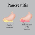 Inflammation of the pancreas. Pancreatitis. Vector illustration on a gray background Royalty Free Stock Photo