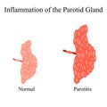 Inflammation of the parotid gland.The structure of the parotid salivary gland. Vector illustration on isolated