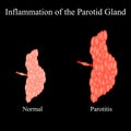 Inflammation of the parotid gland.The structure of the parotid salivary gland. Vector illustration on isolated