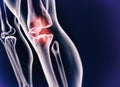 When inflammation strikes. A cgi view of an inflamed joint isolated on blue.