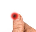 Inflammation at the tip of fingernail. Concept of paronychia at thumb of Asian man. Painful finger