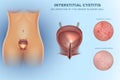 Inflammation of the urinary bladder