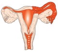 Inflammation of the uterus