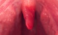 Inflammation of the uvula in the oral cavity due to infection and virus. Treatment of the disease is uvulitis. Red