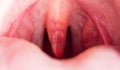 Inflammation of the uvula in the oral cavity due to infection and virus. Treatment of the disease is uvulitis. Red