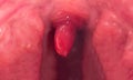 Inflammation of the uvula in the oral cavity due to infection and virus. Treatment of the disease is uvulitis. Red