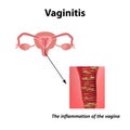 Inflammation of the vagina. Vaginitis. Infographics. Vector illustration on background Royalty Free Stock Photo