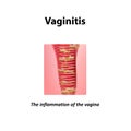 Inflammation of the vagina. Vaginitis. Infographics. Vector illustration on background Royalty Free Stock Photo