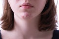 Inflammatory acne on the chin of a teen girl Royalty Free Stock Photo
