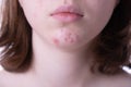 Inflammatory acne spilled out on the chin of a teen girl Royalty Free Stock Photo