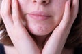 Inflammatory acne rash sprinkled on teen girl chin in close-up Royalty Free Stock Photo