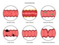 Intestines diseases concept