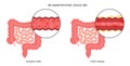 Inflammatory bowel disease