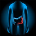 Inflammatory bowel disease