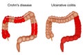 Inflammatory bowel disease. large intestine. Crohn disease and Ulcerative colitis