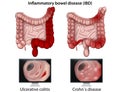 Inflammatory bowel disease medical  illustration on white background Royalty Free Stock Photo