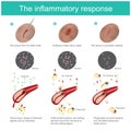 The inflammatory response. Royalty Free Stock Photo