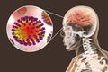 Influenza complication encephalitis Royalty Free Stock Photo