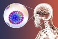 Influenza complication encephalitis Royalty Free Stock Photo