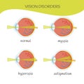 Infografica eyes disease Royalty Free Stock Photo