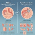 Infographic comparing vaginal birth after cesarean (VBAC) and repeat cesarean Royalty Free Stock Photo