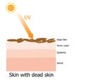 Infographic about dead skin