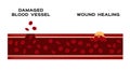 Infographic of how blood vessel heal itself