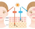 Infographic illustration of difference between UVA and UVB rays.  UV penetration into human skin and woman face. skin care and Royalty Free Stock Photo