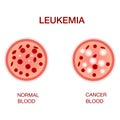 Infographic image of leukemia. Leukaemia disease awareness.Realistic vector