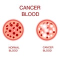 Infographic image of leukemia. Leukaemia disease awareness.Realistic vector