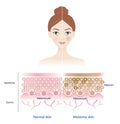 Infographic of normal and melasma skin on woman face vector illustration.