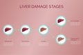 Infographic: stages of liver damage