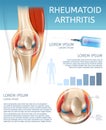 Infographic Treatment Method Rheumatoid Arthritis Royalty Free Stock Photo