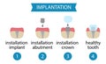 Infographics dental implantation. Process of implant installation.