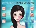 Infographics of different type of skin acne Royalty Free Stock Photo