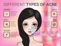 Infographics of different type of skin acne Royalty Free Stock Photo