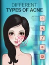 Infographics of different type of skin acne Royalty Free Stock Photo