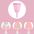 Infographics of menstrual cup. Menstrual cup - feminine hygiene product, device for collecting blood during menstruation