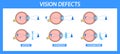 Informative Chart Detailing Myopia, Hyperopia, And Astigmatism In Eye Anatomy. Vector Visual Comparison