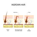 Ingrown hair after hair removal and shaving Royalty Free Stock Photo