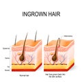 Ingrown hair Royalty Free Stock Photo