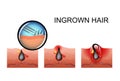 Ingrown hair, pimple ripening