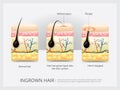 Ingrown Hair Structure